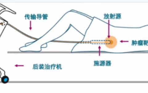 80%癌症患者不敢接受的放疗，怕痛的她做到了…..
