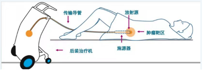 80%癌症患者不敢接受的放疗，怕痛的她做到了…..