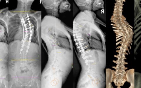 1036天的牵引马拉松​：重度“扭曲”少年“重塑”人生