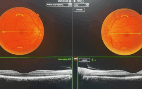 优质医疗资源下沉“抢”光明：万宁患者重见清晰世界