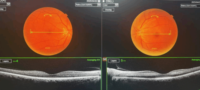 优质医疗资源下沉“抢”光明：万宁患者重见清晰世界