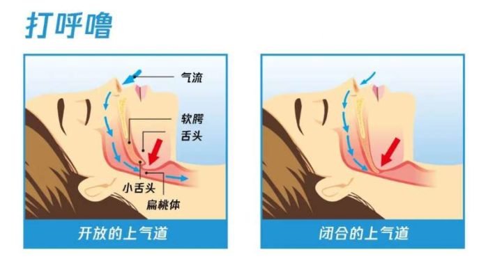 你的鼾声可能是身体发出的求救信号——两招教你走出“打鼾如雷就是睡得香”的误区