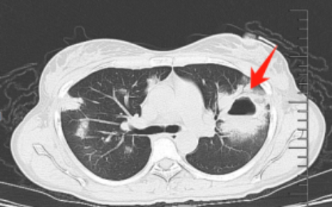 海医二院破解“会伪装的罕见病”