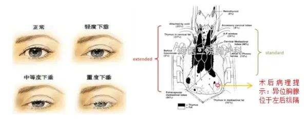 海医二院微创手术助力眼肌型重症肌无力患者重获“睛”彩人生