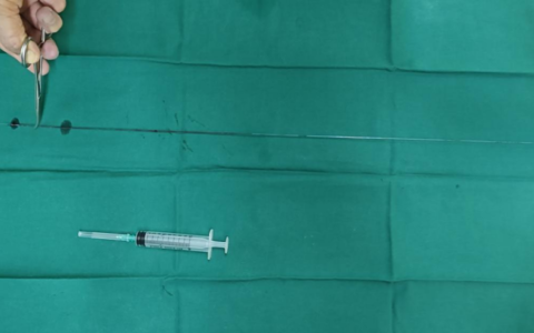 突破置管技术难关彰显医疗服务实力 解放军总医院海南医院成功突破PICC置管拔除难题