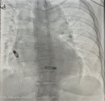 瑞金海南医院完成中国大陆地区首例AVEIR™ DR植入手术