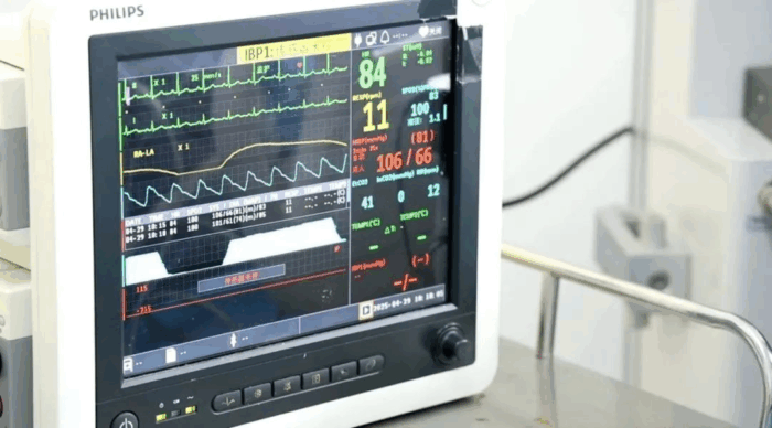 海南省人民医院定安分院成功实施首例内镜下胃底肿物黏膜下挖除术（ESE）