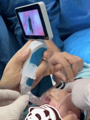 “趴睡宝宝”获救了！海南省人民医院多学科团队为2月龄宝宝重建“生命气道”