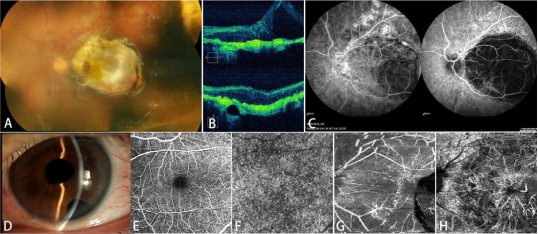 千里求医，8年黑暗一朝破！海南医生用这项技术让新疆患者重见光明