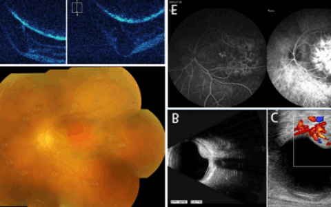 千里求医，8年黑暗一朝破！海南医生用这项技术让新疆患者重见光明