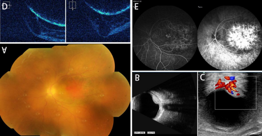千里求医，8年黑暗一朝破！海南医生用这项技术让新疆患者重见光明