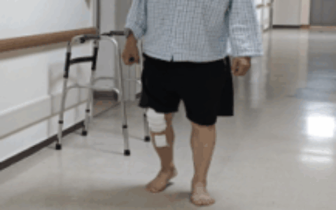 机器人辅助膝关节单髁置换术落地海口市骨科与糖尿病医院