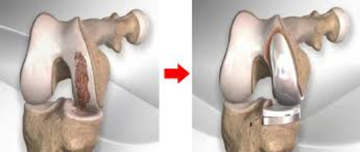 机器人辅助膝关节单髁置换术落地海口市骨科与糖尿病医院