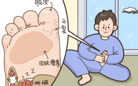 警惕！你以为的 “缺水脚跟”，实则是脚气的 “潜伏计划”