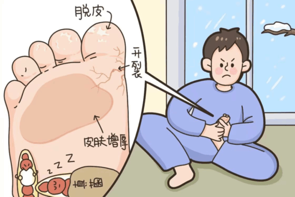 警惕！你以为的 “缺水脚跟”，实则是脚气的 “潜伏计划”