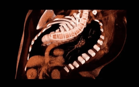 当脊柱侧弯遇上食管裂孔疝， 海南省人民医院多学科联合精准诊疗！