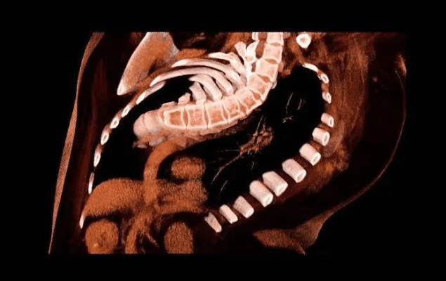 当脊柱侧弯遇上食管裂孔疝， 海南省人民医院多学科联合精准诊疗！