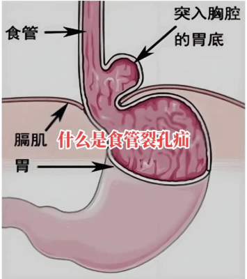 当脊柱侧弯遇上食管裂孔疝， 海南省人民医院多学科联合精准诊疗！