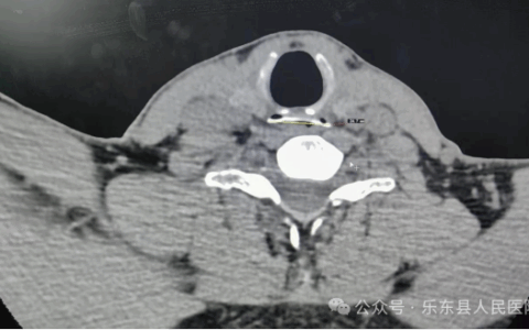 乐东县人民医院多学科协作成功化解食管异物危机