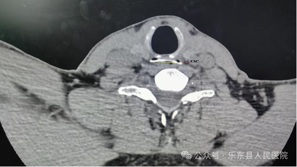 乐东县人民医院多学科协作成功化解食管异物危机