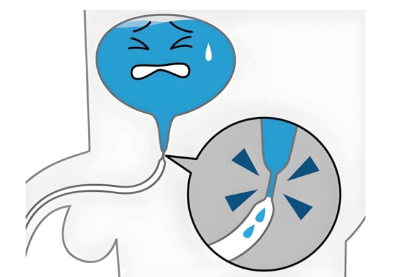 尿道狭窄别硬扛！七旬老人尿道扩张术后直呼“轻松”