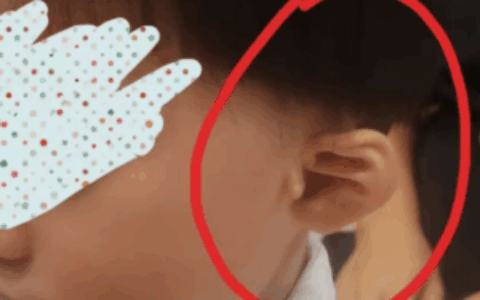  “一下”搞定宝宝耳朵不对劲？海医二院耳鼻咽喉头颈外科开展新生儿耳廓无创矫形新技术