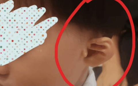  “一下”搞定宝宝耳朵不对劲？海医二院耳鼻咽喉头颈外科开展新生儿耳廓无创矫形新技术