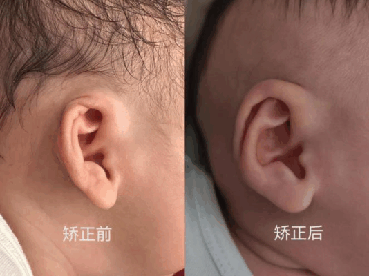  “一下”搞定宝宝耳朵不对劲？海医二院耳鼻咽喉头颈外科开展新生儿耳廓无创矫形新技术