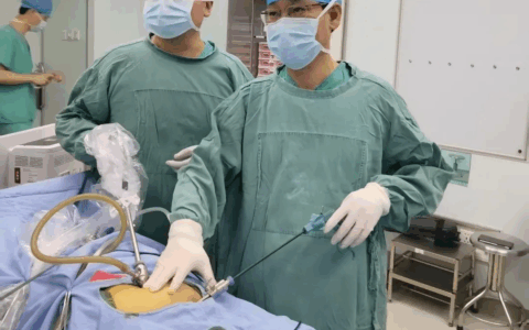 定安100kg患者在“家门口”成功接受双孔腹腔镜阑尾切除术