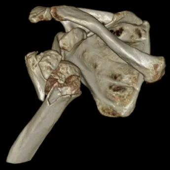 海南医科大学第二附属医院成功开展医院首例反肩关节置换术