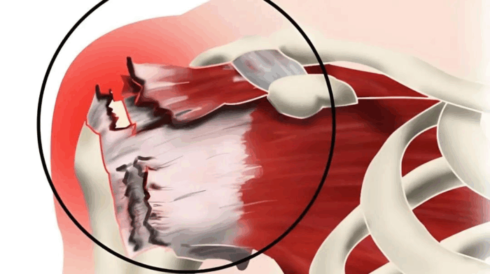 术后第二天就抬手！海南省人民医院破解高龄巨大肩袖撕裂治疗难题