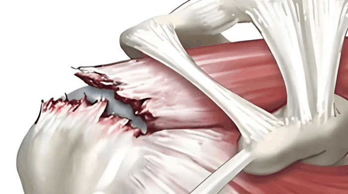 术后第二天就抬手！海南省人民医院破解高龄巨大肩袖撕裂治疗难题