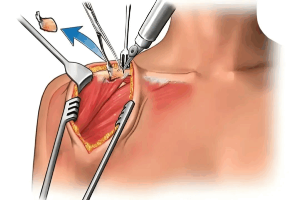 术后第二天就抬手！海南省人民医院破解高龄巨大肩袖撕裂治疗难题