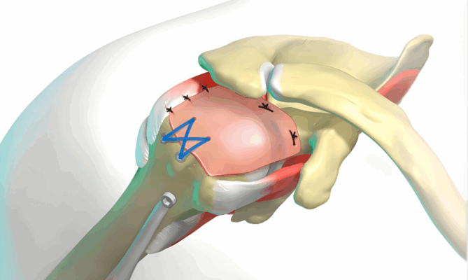 术后第二天就抬手！海南省人民医院破解高龄巨大肩袖撕裂治疗难题