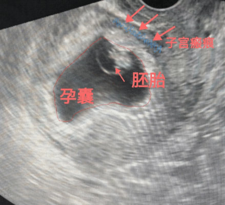 孕囊长在剖宫产刀口上？凶险瘢痕妊娠，生死一线！