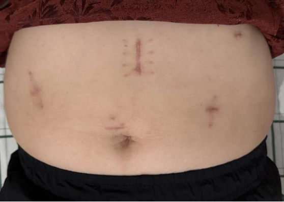 从绝望到希望:一位晚期胆管癌患者的生命逆袭