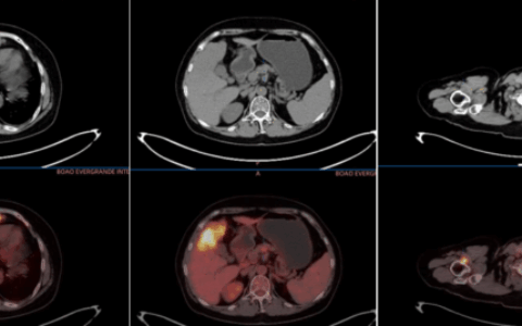 从绝望到希望：一位晚期胆管癌患者的生命逆袭