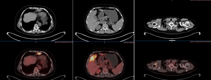 从绝望到希望:一位晚期胆管癌患者的生命逆袭