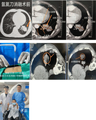 海南首例：冰火“双术”点燃生命希望，晚期肺癌消融联合免疫治疗显奇效