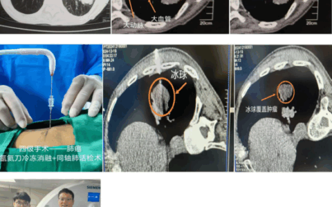 海南首例：冰火“双术”点燃生命希望，晚期肺癌消融联合免疫治疗显奇效