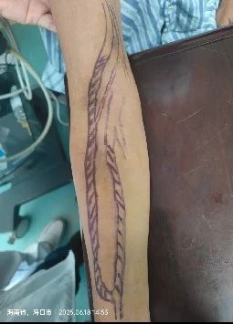 内瘘遭遇血栓！海南省人民医院多学科联合，巧用“利器”抢修透析“生命线”