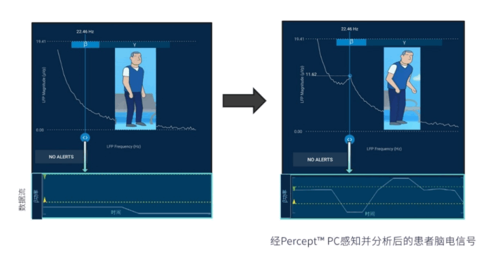 海南首例智能脑起搏器植入术实现帕金森病精准治疗!