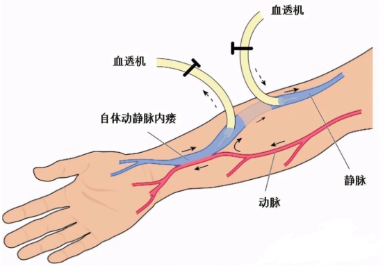 内瘘遭遇血栓！海南省人民医院多学科联合，巧用“利器”抢修透析“生命线”