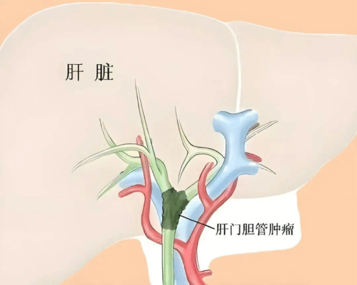 同期完成两台高难度腹腔镜手术！省医肝胆外科勇闯高龄禁区 书写生命奇迹