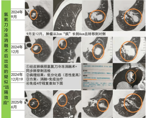 海南首例：冰火“双术”点燃生命希望，晚期肺癌消融联合免疫治疗显奇效