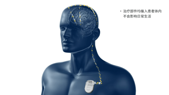 海南首例智能脑起搏器植入术实现帕金森病精准治疗!