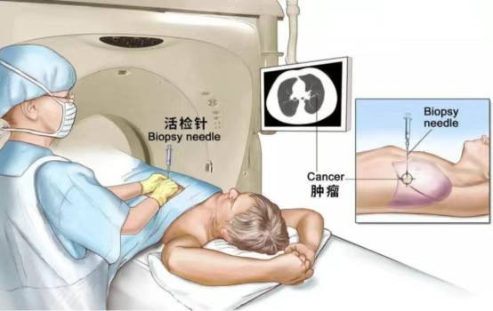 海南省人民医院定安分院成功开展首例CT引导下经皮肺穿刺活检术