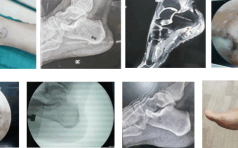 上海六院海口医院微创技术破解顽固性“跟痛症”