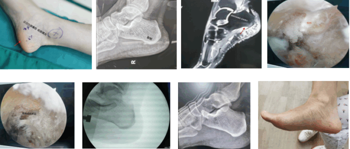 上海六院海口医院微创技术破解顽固性“跟痛症”