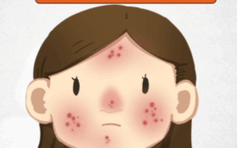 别让“酒渣鼻”毁了颜值！警惕玫瑰痤疮这个“颜值小偷”